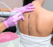 Removing Tattoos Safely: Why Choose a Professional Laser Treatment