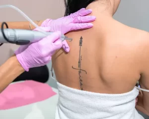 Removing Tattoos Safely: Why Choose a Professional Laser Treatment