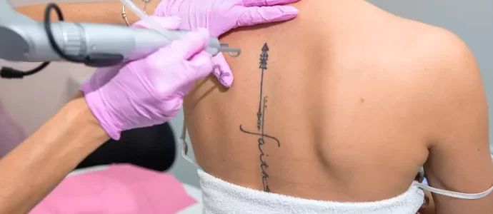 Removing Tattoos Safely: Why Choose a Professional Laser Treatment